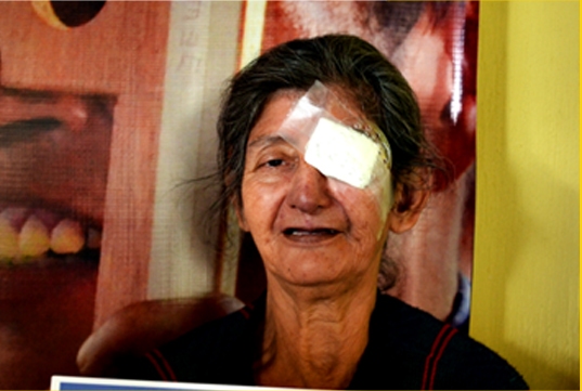 Fotografía de una paciente después de haberse realizado una cirugía de catarata gratuita por el día mundial de la visión en visualiza