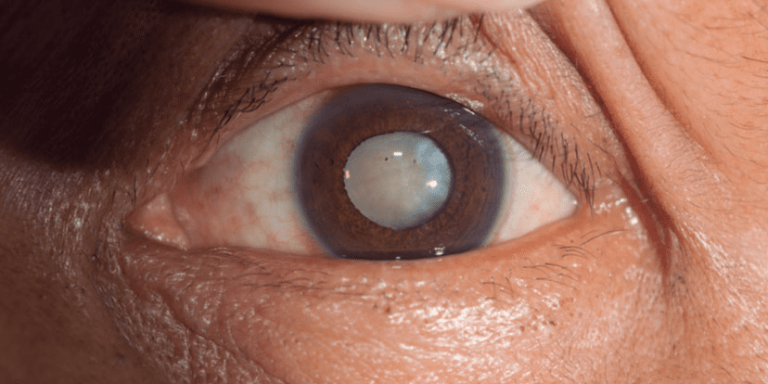 Fotografía de un ojo con catarata