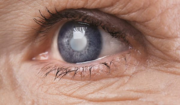 fotografía de un ojo con catarata